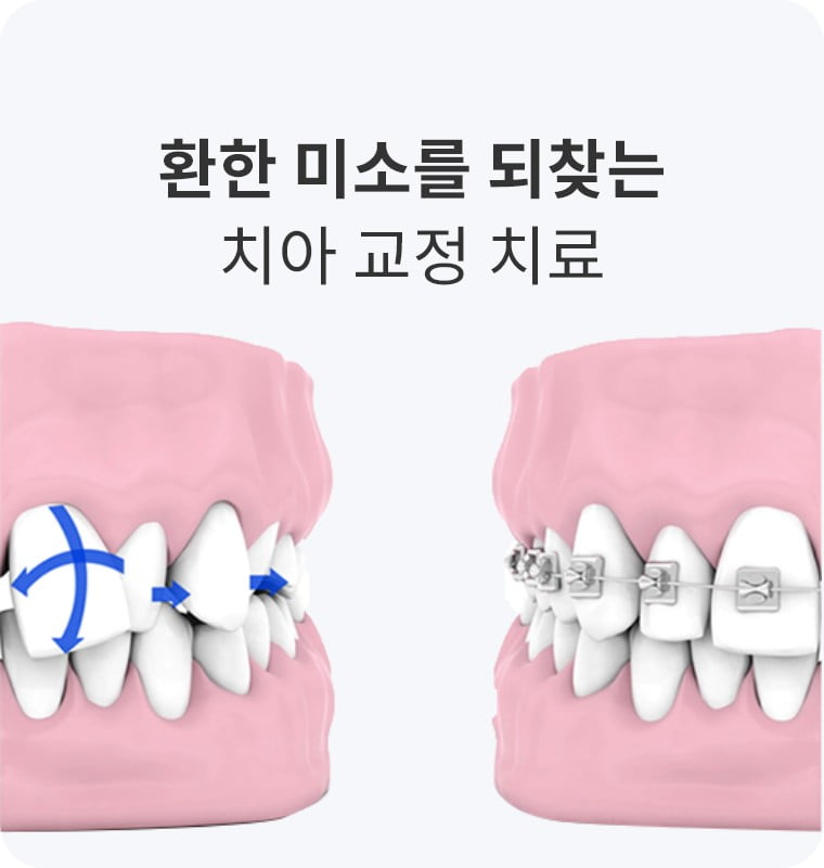 환한 미소를 되찾는 치아 교정 치료